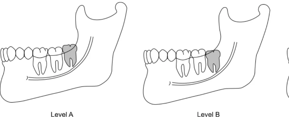Fig. 1. Pell - Gregory classification; Depth of impacted mandibular 3 rd  molar.치아의  존재  여부  등  여러  가지  요인에  영향을  받을  수  있으며[7], Neal  등[8]은  하악골  골절의  50%가  치아와  연관되어  나타난다고 보고하기도  하였다