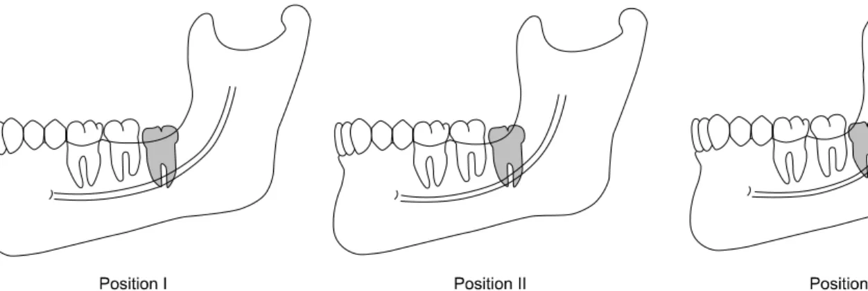 Fig. 3. Angulation of mandibular 3 rd molar. Clockwise from top left: 