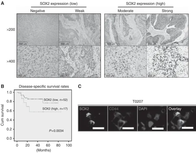 Figure 1. SOX2 expression in primary HNSCC specimens. (A) Immunohistochemical analysis of expression of SOX2 from primary HNSCC specimens (magnification:  200 and  400)
