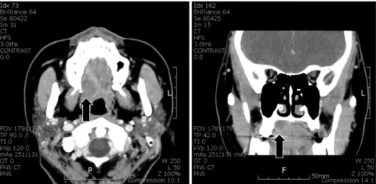 Fig. 2. CT scans representing a well enveloped and heterogeneously  enhancing mass on palatal area  (arrow).(1943)가  다형성선종으로  명명하였다[1]