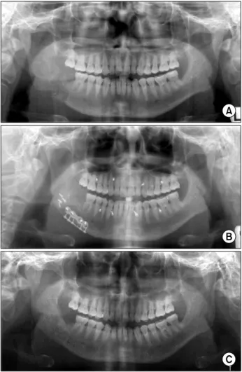 Fig. 1. Mandible fracture resulting from odontogenic keratocyst.