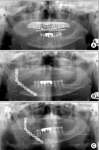 Fig. 3. Mandible fracture resulting from oral squamous cell  carcinoma (A) Panoramic view showing pathologic fracture and bony destruction resulting from oral squamous cell carcinoma.