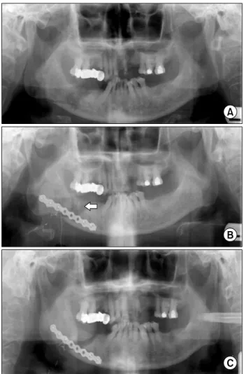 Fig. 4. Mandible fracture resulting from osteomyelitis. (A)  Panoramic view showing pathologic fracture of mandible body  following sequestrectomy and saucerization of mandible  osteo-myelitis