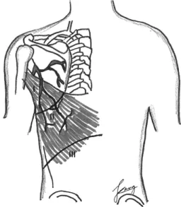 Fig. 5. Schematic drawing of three primary angiosomes of  latissimus dorsi muscle.