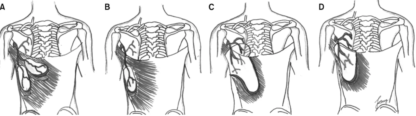 Fig. 9. Designing of skin island. (A) One skin island oriented distal-obliquely. (B) Two skin islands may be oriented transversely and  obliquely