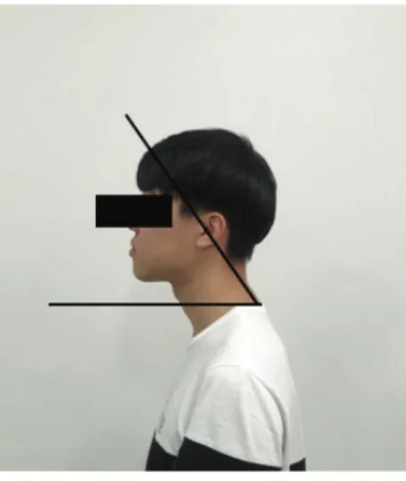 Fig.  1.  Craniovertebral  angle,  CVA.