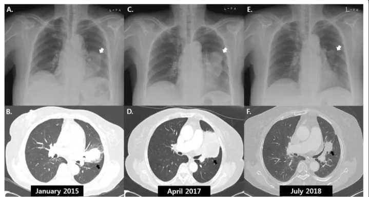 Fig. 1 Serial chest radiographs and computed tomography scans of a 74-year-old woman with spontaneous remission of non-small cell lung cancer