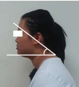 Fig.  1.  Measurement  of  craniovertebral  angle.