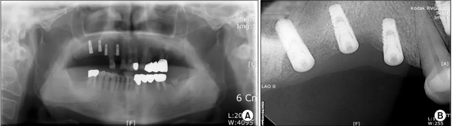 Fig. 4. Guided bone regeneration was performed on peri-implant bone defect area.