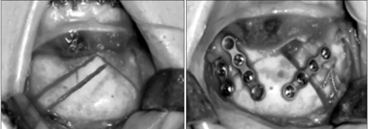 Fig. 6. Genioplasty was performed.
