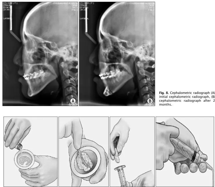 Fig. 8. Cephalometric radiograph (A) initial cephalometric radiograph, (B) cephalometric radiograph after 2  months.
