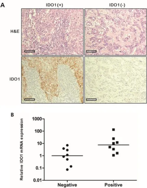 Figure 1. A. IDO1(+) tumor exhibits conspicuously dense stromal lymphocytic infiltration compared with IDO1( −) tumor (×200 magnification)