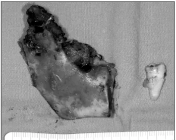 Fig. 6. Immediate post-operative PET-CT shows the uptake of FDG on right mandible area and cervical lymph nodes (right level I, II, III and left level II)