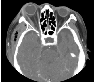 Fig. 1. Panoramic view showing periapical lesion on Rt. Mx. 2 nd molar.