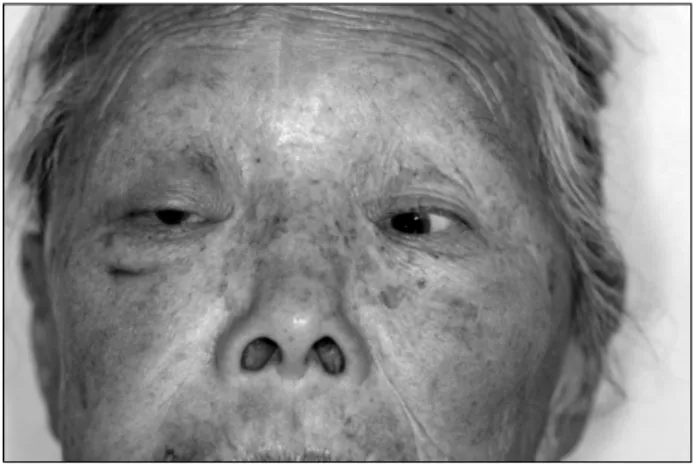 Fig. 4. Swelling of right upper eyelid and proptosis of the right