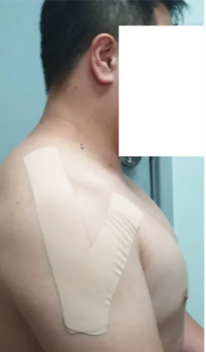 Fig. 2. Motion taping method - deltoid middle &amp; posterior.