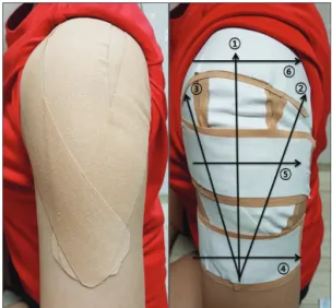 Fig. 1. Jeonbuk tri-pull taping.