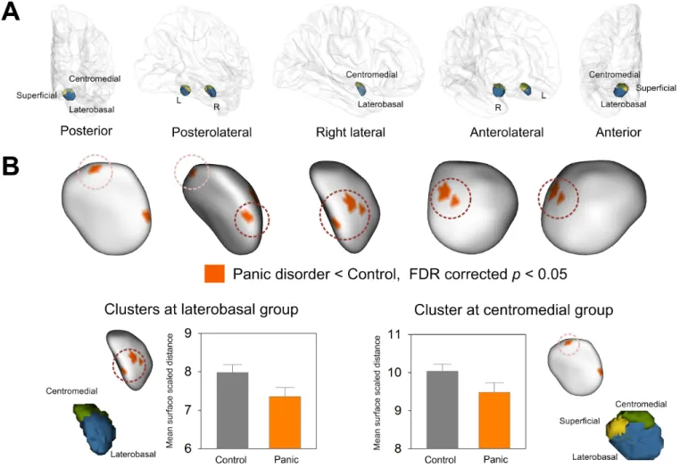 Fig 2. Clusters showing significant surface inward deformation in patients with panic disorder relative to healthy controls