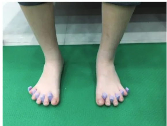 Fig. 1. Toe wedge.