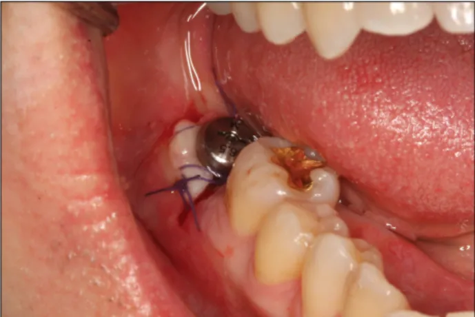 Fig. 8. Periapical radiograph 14 months after final prosthetic  delivery. 