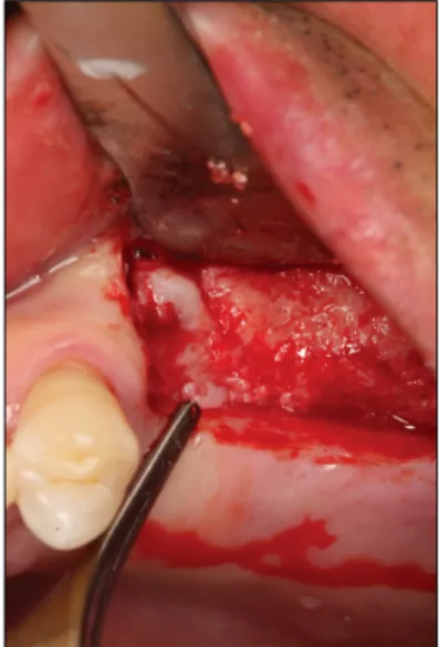 Fig. 11. Autogenous tooth block was grafted into the extraction socket.
