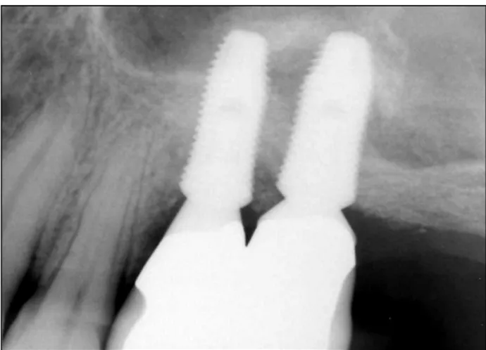 Fig. 17. Periapical radiograph 6 months after final prosthetic  delivery.