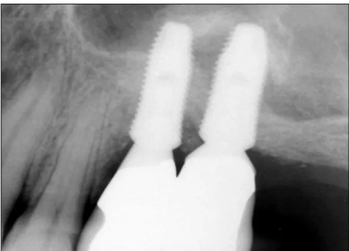 Fig. 17. Periapical radiograph 6 months after final prosthetic  delivery.