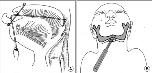 Fig. 2. Schematic representation of the modified TLA from Smith et al.