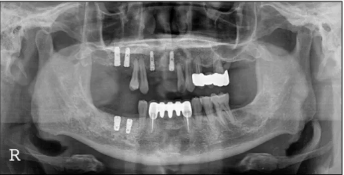 Fig. 7. Maxillary right posterior area was exposed for implant  placement 4 months after ridge augmentation