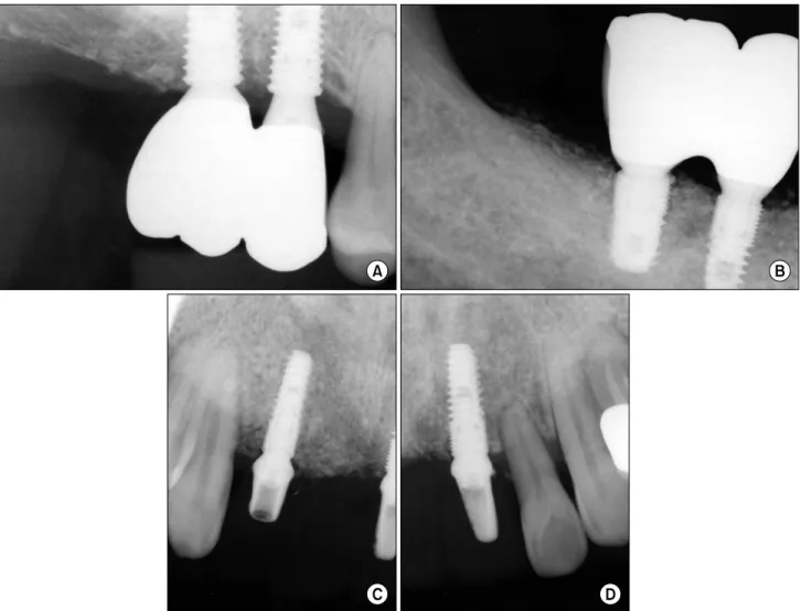 Fig. 9. Radiography and intraoral photography after final prosthetic delivery. (A) Right maxillary posterior area periapical radiography.