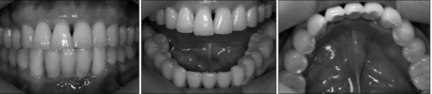 Fig. 4. On postoperative 3 days clinical examination, swelling in the floor of the mouth was subsided and active bleeding was not observed