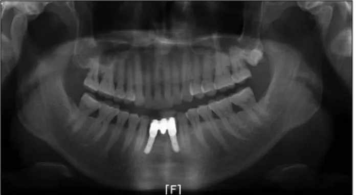 Fig. 6. Panoramic radiograph with prosthesis set up 16 weeks after the surgery.