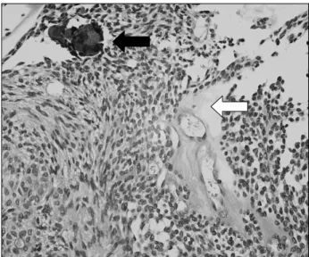 Fig. 1. Panoramic radiograph and  CBCT. Well defined, unilocular  ra-diolucent lesion with internal  radio-opaque foci on impacted #34  peri-coronal area.