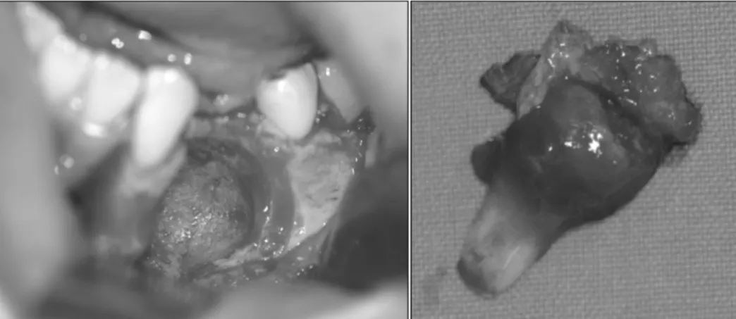 Fig. 3. Resected tumor.