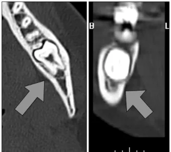 Fig. 1. Preoperative panorama view. We verified partial impaction left third molar and horizontal complete impaction second molar.