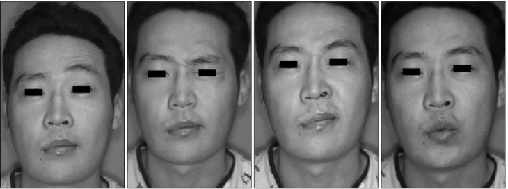 Fig. 2. Postoperative clinical photograph (post operative day #11).