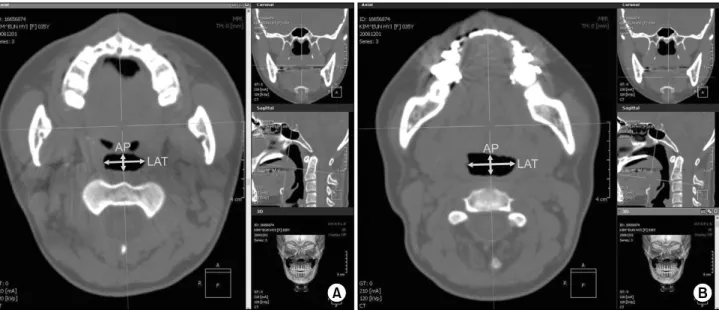 Fig. 4. The AP and LAT in the level of C2 and C3 (A, C2 level; B, C3 level). AP, anterioposterior dimension on the midsagittal plane;