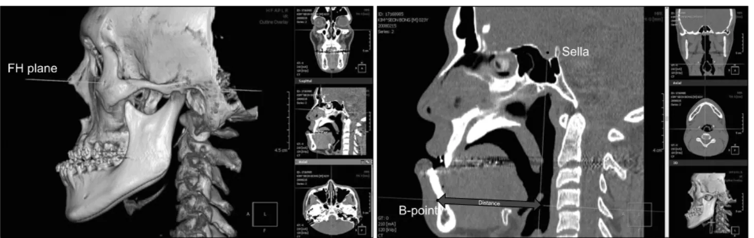 Fig. 5. The AREA in the level of C2 and C3 (A, C2 level; B, C3 level). AREA, cross-sectional area of the airway.