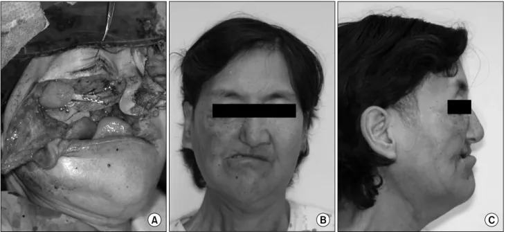 Fig. 3. After the Lateral arm free flap reconstruction of palate, the patient still showed maxillary depression