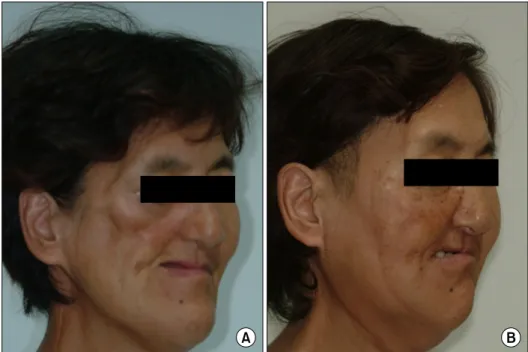 Fig. 5. Preoperative (A) and final  postoperative (B) views of the  patient. 변형과  비대칭을  쉽게  야기시킨다[9,10]
