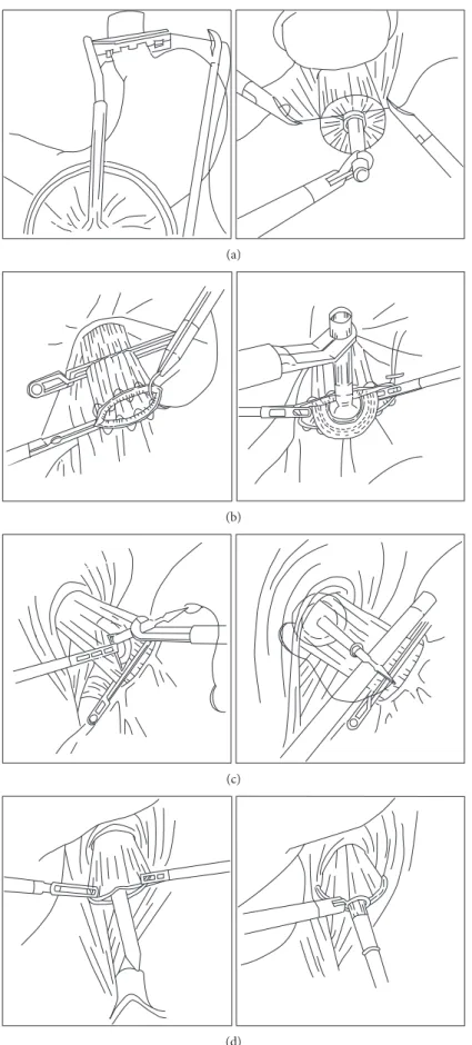 Figure 1: The several methods of anvil insertion for esophagojejunostomy using a circular stapler after total gastrectomy