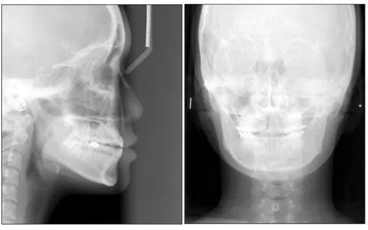 Fig. 2. Pre-operative cephalo- cephalo-metric &amp; skull PA change.