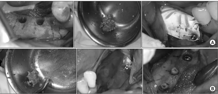 Fig. 2. (A) Mandibular right molar area, vertical ridge augmentation using TRG. (B) Mandibular left molar area, vertical ridge augmentation using Ti-mesh