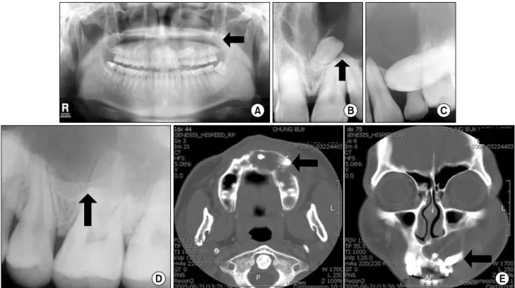 Fig. 1. (A) Pre-Operative Panoramic view showed the presence of a large, well-defined, radiolucent lesion extending from the right  maxillary central incisor to the mesial aspect of the left maxillary second molar