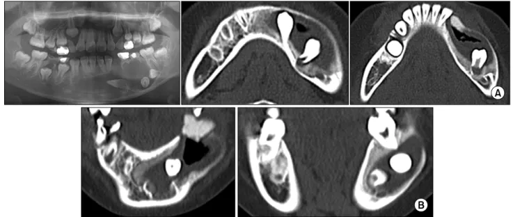 Fig. 1. (A) Pre-operative panoramic view. Left mandibular canine, first premolar, second premolar were displaced toward mandibular inferior border due to dentigerous cyst