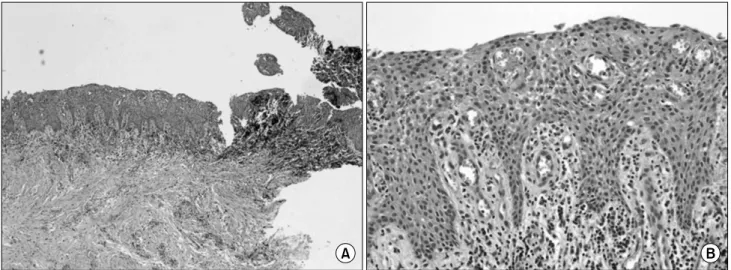 Fig. 2. This inflamed dentigerous cyst showed a thicker epithelial lining with hyperplastic rete ridges