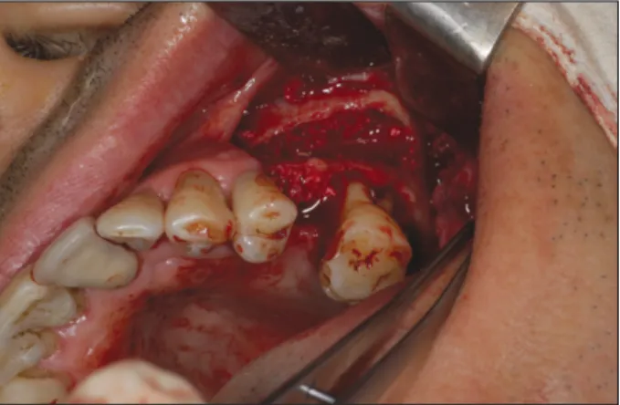 Fig. 1. Sinus membrane thickening on preoperative dental CT.  Fig. 2. After sinus elevation and bone graft through lateral approach.