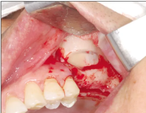 Fig. 7. A, Hole making to communicate with sinus superior than bone-grafted site; B, Inserting silastic drain.