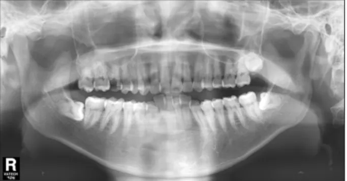Fig. 2. Panoramic  radiography:  Deep  caries  on  maxillary right first molar.