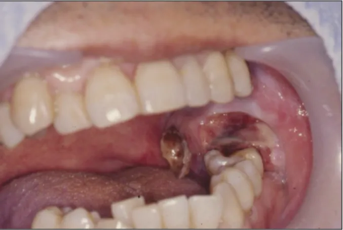 Fig. 1. Initial panoramic view. Fig. 2. Gingival &amp; mucosal bleeding view around mandibular left first molar in oral metastatic carcinoma.